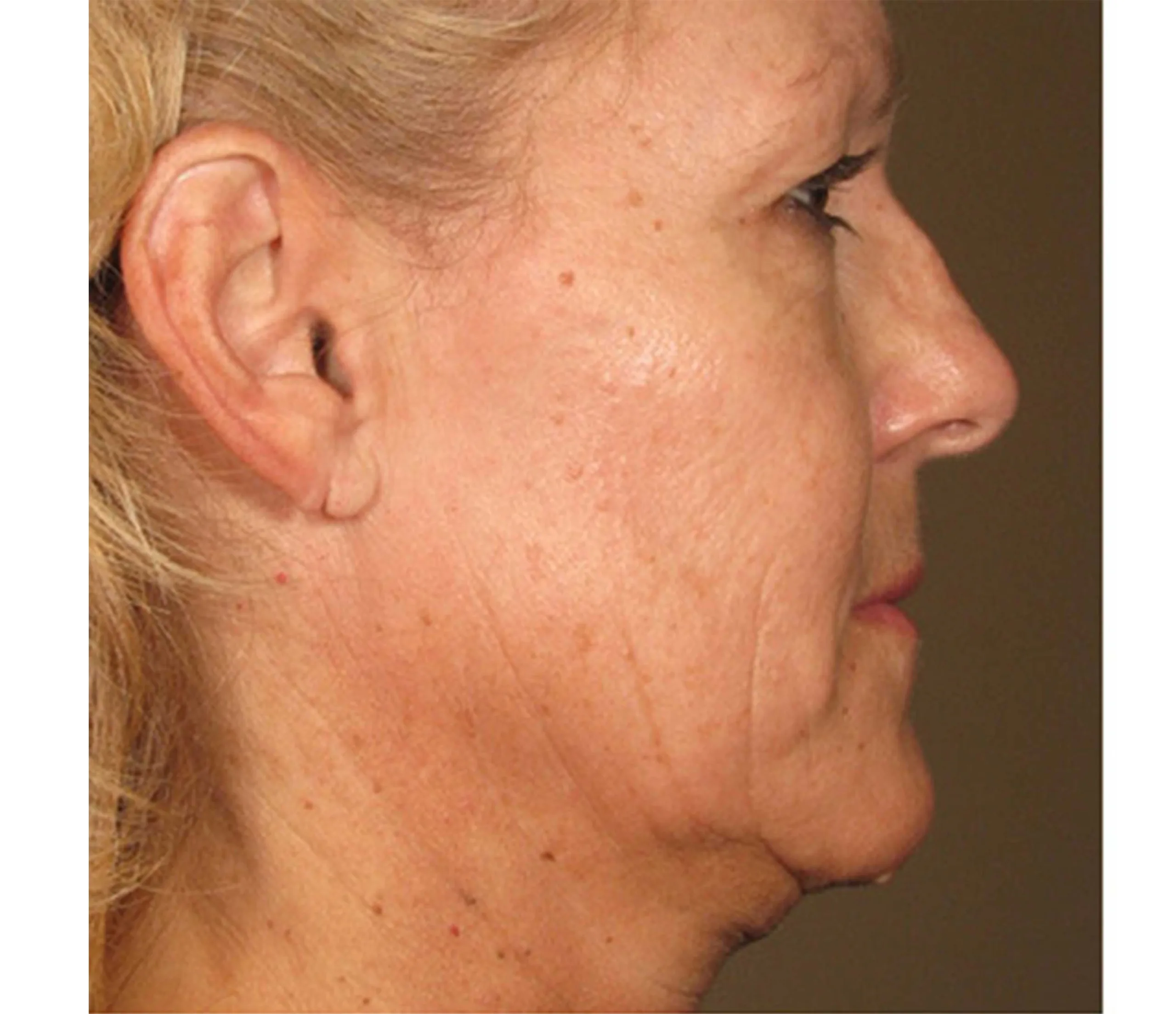 Before result image